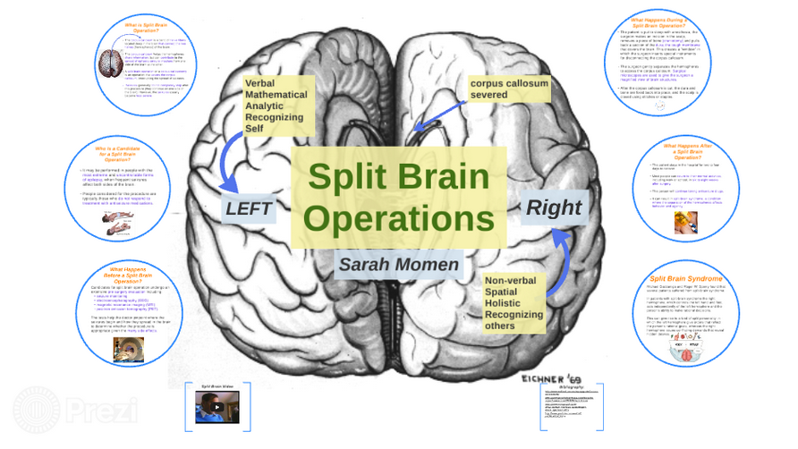Split brain. Функциональная гемисферэктомия.